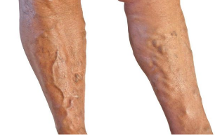 Behandlung von Krampfadern in den Beinen.