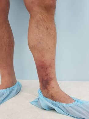 Komplikationen durch Krampfadern bei Männern