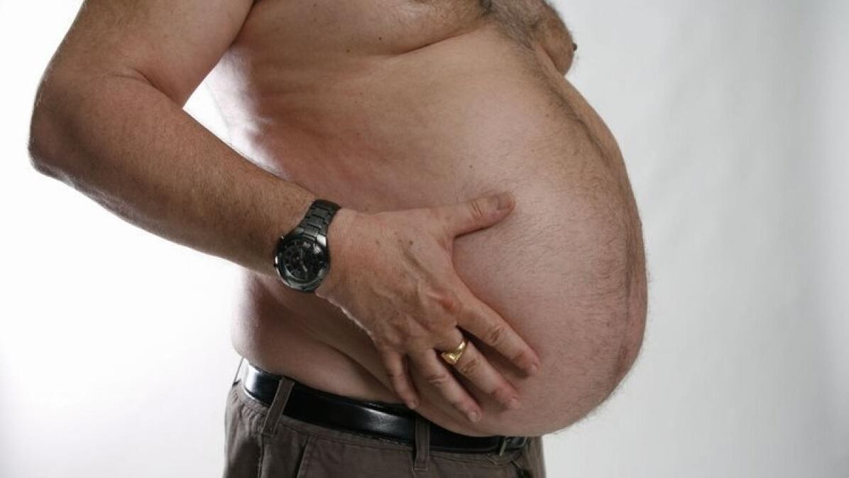 Fettleibigkeit als Ursache für die Entstehung von Krampfadern