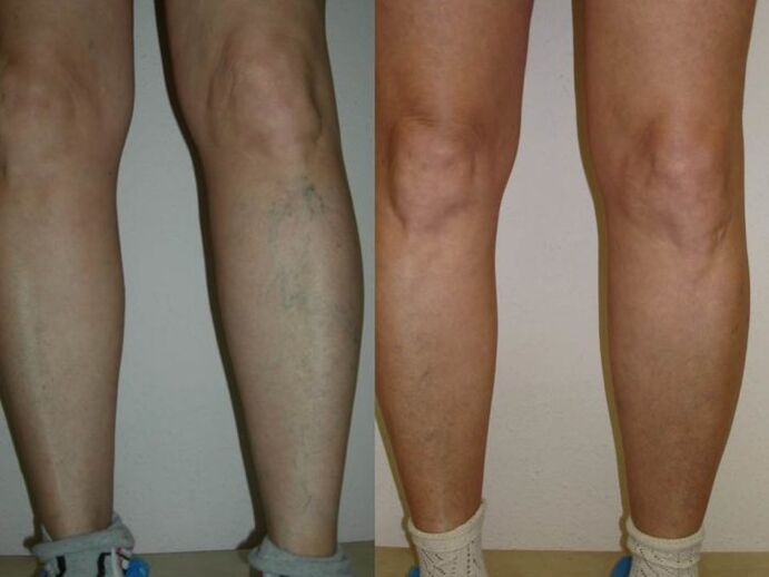 Beine vor und nach der Laserbehandlung von Krampfadern